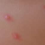 shingles