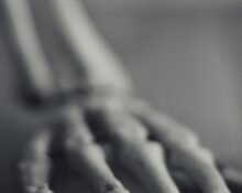 The USFDA has approved GSK Plc’s oral therapy to treat anaemia in patients with myelofibrosis, a type of bone cancer.