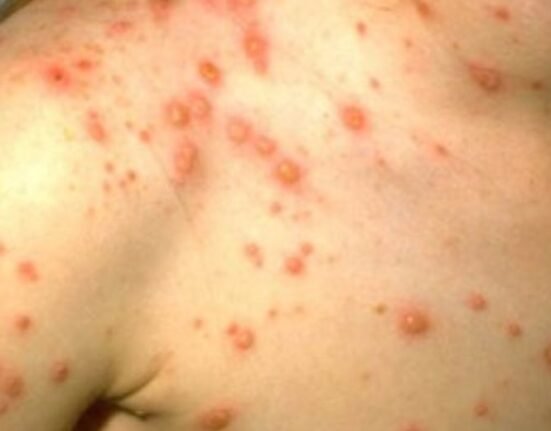 Chickenpox is an acutely contagious disease caused by the VZV. If one person has chicken pox, up to 90% of those close to that person, who are not immune, will also become infected. 