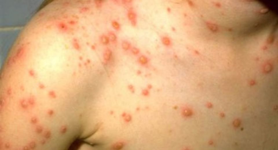 Chickenpox is an acutely contagious disease caused by the VZV. If one person has chicken pox, up to 90% of those close to that person, who are not immune, will also become infected. 