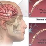 Contineum Therapeutics, Inc., a US San Diego-headquartered biopharmaceutical company’s trial drug may reverse multiple sclerosis damage by potentially restoring movement and function.
