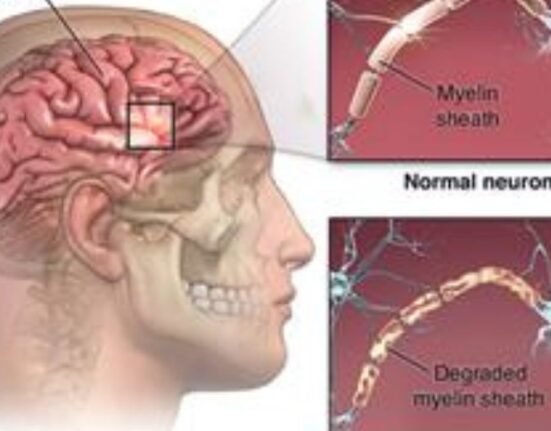 Contineum Therapeutics, Inc., a US San Diego-headquartered biopharmaceutical company’s trial drug may reverse multiple sclerosis damage by potentially restoring movement and function.