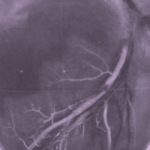 A new cardiovascular disease risk calculator may render 16 million US citizens ineligible for preventive therapy if the current guidelines for cholesterol and high blood pressure treatment remain the same, according to a Harvard Medical School study.