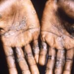 The World Health Organization has appealed for $87.4 million over the next six months to stop and contain the current global outbreak of mpo