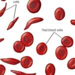 Pfizer Inc.’s sickle cell therapy involving Oxbryta has been voluntarily withdrawn from global markets due to painful complications and death, according to a company statement.