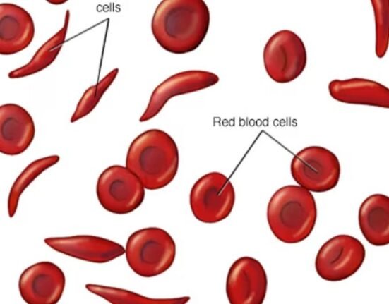 Pfizer Inc.’s sickle cell therapy involving Oxbryta has been voluntarily withdrawn from global markets due to painful complications and death, according to a company statement.