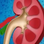 Researchers have found genomic variants in one-third of people from the West African countries of Ghana and Nigeria that significantly increase the risk of developing kidney diseases.