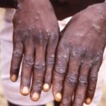 The World Health Organization will hold an emergency meeting on November 22 to decide whether mpox continues to be a public health emergency of international concern.
