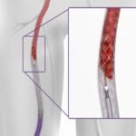 US-based medical device maker Stryker Corporation will acquire Inari Medical Inc., for about $4.9 billion to expand the former’s neurovascular business.