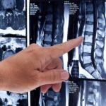 The US drug regulator has issued its most prominent warning on the use of certain drugs to treat multiple sclerosis, saying it may cause hospitalisation and death due to a “rare but serious” allergic reaction.