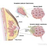 Annual deaths caused by breast cancer globally will rise 68% to 1.1 million by 2050, according to a report from the International Agency for Research on Cancer, a specialised arm of the World Health Organization.