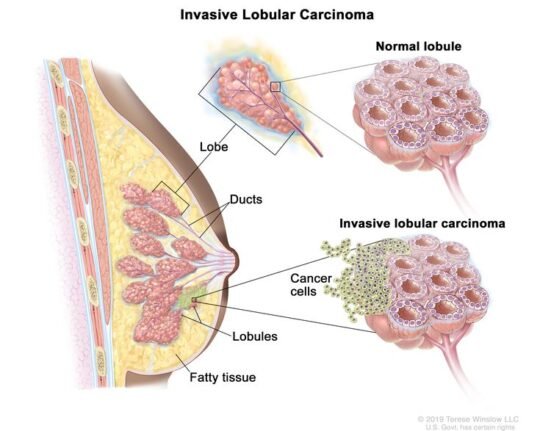 Annual deaths caused by breast cancer globally will rise 68% to 1.1 million by 2050, according to a report from the International Agency for Research on Cancer, a specialised arm of the World Health Organization.