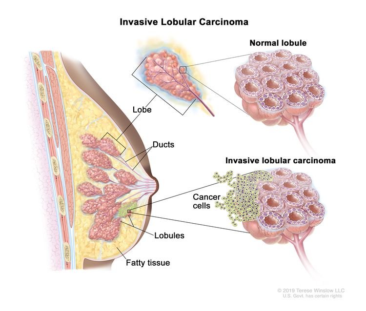 Annual deaths caused by breast cancer globally will rise 68% to 1.1 million by 2050, according to a report from the International Agency for Research on Cancer, a specialised arm of the World Health Organization.