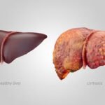 More than 84% of 345 information technology workers surveyed in an Indian city suffer from non-alcoholic fatty liver disease due to sedentary lifestyles, posing a significant health challenge, according to a study.