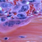 Merck & Co. got approval from the US Food and Drug Administration for a pill to treat a rare type of tumour in adults and children aged above 12 years, according to a statement.