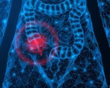 Appendiceal cancer tripled in Americans born between 1976 and 1984 and quadrupled for those born between 1981 and 1989, according to a study.