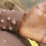 Mpox cases continue to surge and meet the criteria of a public health emergency of international concern, the World Health Organization stated.