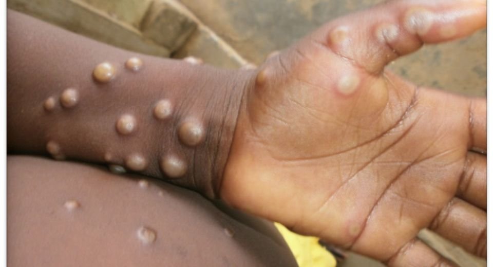 Mpox cases continue to surge and meet the criteria of a public health emergency of international concern, the World Health Organization stated.
