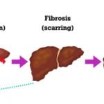 Madrigal Pharmaceuticals EU Limited's therapy to treat adults with noncirrhotic metabolic dysfunction-associated steatohepatitis (MASH) got a conditional marketing authorisation in the European Union.