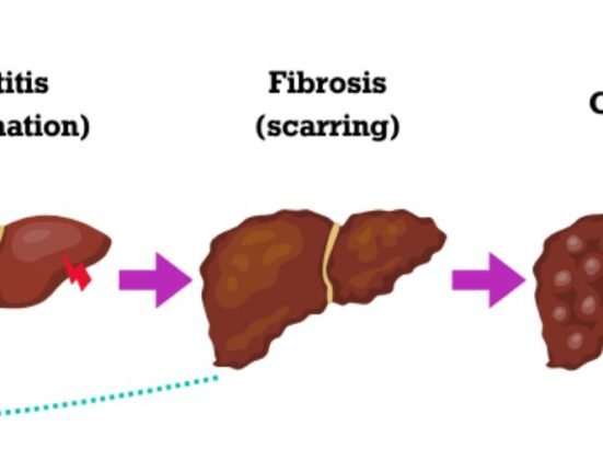 Madrigal Pharmaceuticals EU Limited's therapy to treat adults with noncirrhotic metabolic dysfunction-associated steatohepatitis (MASH) got a conditional marketing authorisation in the European Union. 