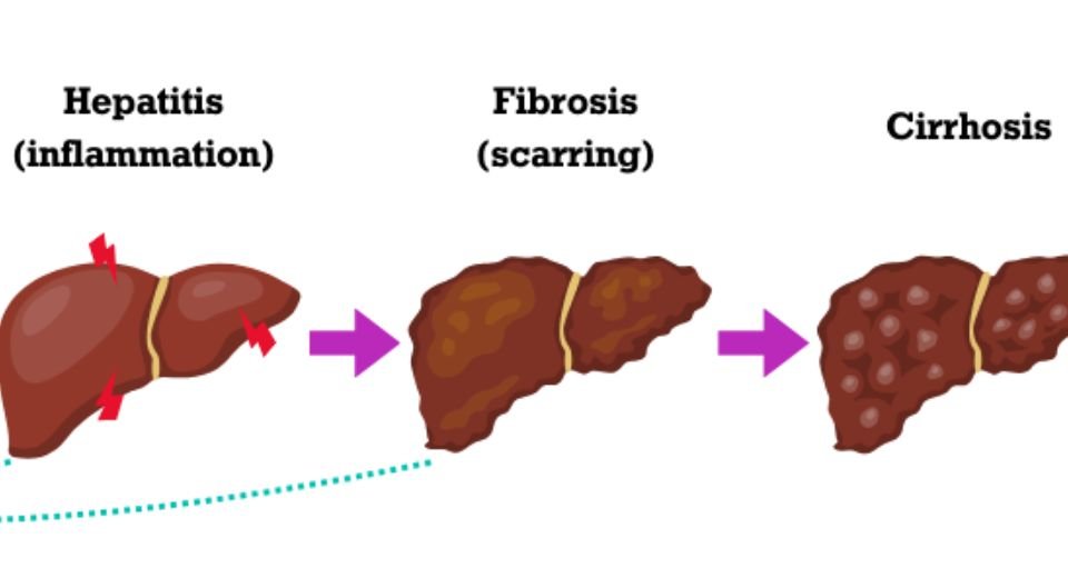 Madrigal Pharmaceuticals EU Limited's therapy to treat adults with noncirrhotic metabolic dysfunction-associated steatohepatitis (MASH) got a conditional marketing authorisation in the European Union. 