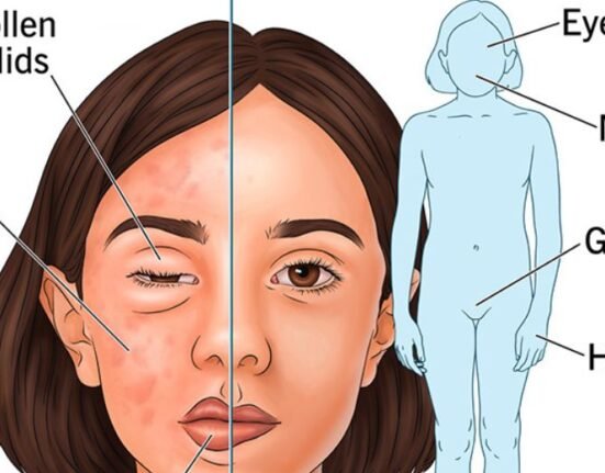 KalVista Pharmaceuticals Inc.'s medicine to treat hereditary angioedema, a rare disease that causes sudden and severe swelling attacks in the body, got approval from the US regulator. 