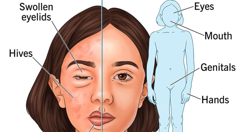 KalVista Pharmaceuticals Inc.'s medicine to treat hereditary angioedema, a rare disease that causes sudden and severe swelling attacks in the body, got approval from the US regulator. 
