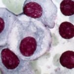 Regeneron Pharmaceuticals, Inc.’s drug for a type of blood cancer in patients who have received four treatments before, and the disease has recurred, has received the US regulator’s green light.