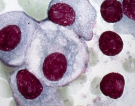 Regeneron Pharmaceuticals, Inc.’s drug for a type of blood cancer in patients who have received four treatments before, and the disease has recurred, has received the US regulator’s green light.