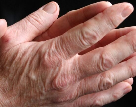 Johnson & Johnson has stopped a mid-trial evaluation of a combination drug to treat people with a type of arthritis after the therapy failed to show “sufficient evidence” of benefit to the patients.