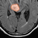Jazz Pharmaceuticals Plc’s treatment for a rare and aggressive brain tumour that affects children and adults got approval from the US regulator.