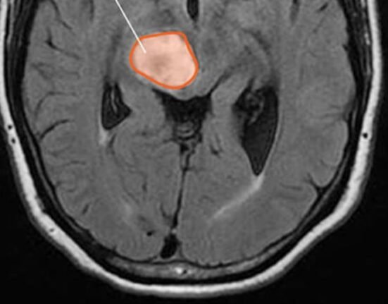 Jazz Pharmaceuticals Plc’s treatment for a rare and aggressive brain tumour that affects children and adults got approval from the US regulator.