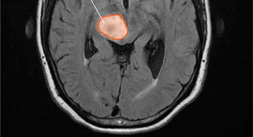 Jazz Pharmaceuticals Plc’s treatment for a rare and aggressive brain tumour that affects children and adults got approval from the US regulator.