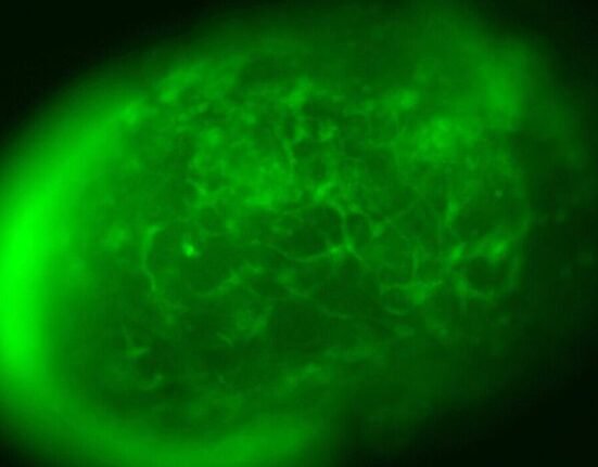 Excess fat present in the brain’s immune cells impairs their ability to combat diseases such as Alzheimer’s, research from US-based Purdue University reveals.