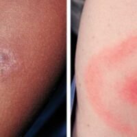 Pfizer Inc. and France-based Valneva SE's investigational vaccine has shown 70% efficacy in preventing Lyme disease in individuals aged five and above.