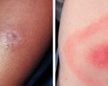 Pfizer Inc. and France-based Valneva SE's investigational vaccine has shown 70% efficacy in preventing Lyme disease in individuals aged five and above.