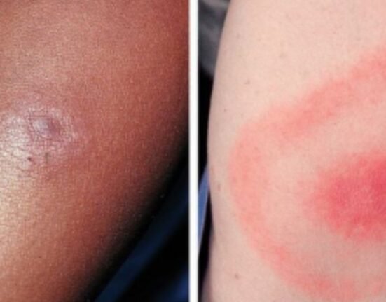 Pfizer Inc. and France-based Valneva SE's investigational vaccine has shown 70% efficacy in preventing Lyme disease in individuals aged five and above.