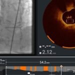 US FDA clears Abbott Laboratories' new software to clear heart blockages.