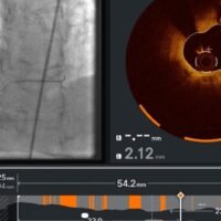 US FDA clears Abbott Laboratories' new software to clear heart blockages.