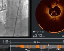 US FDA clears Abbott Laboratories' new software to clear heart blockages.