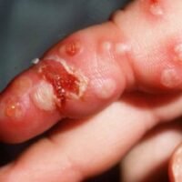 The US Food and Drug Administration has approved Asahi Kasei Therapeutics, Inc’s oral drug to treat mucocutaneous lesions caused by herpes simplex virus (HSV) for adults with weakened immune systems.