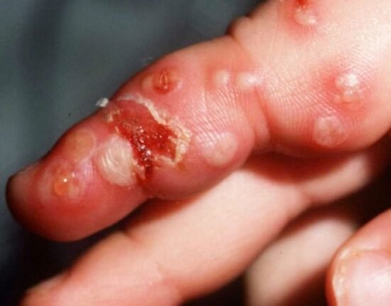 The US Food and Drug Administration has approved Asahi Kasei Therapeutics, Inc’s oral drug to treat mucocutaneous lesions caused by herpes simplex virus (HSV) for adults with weakened immune systems.